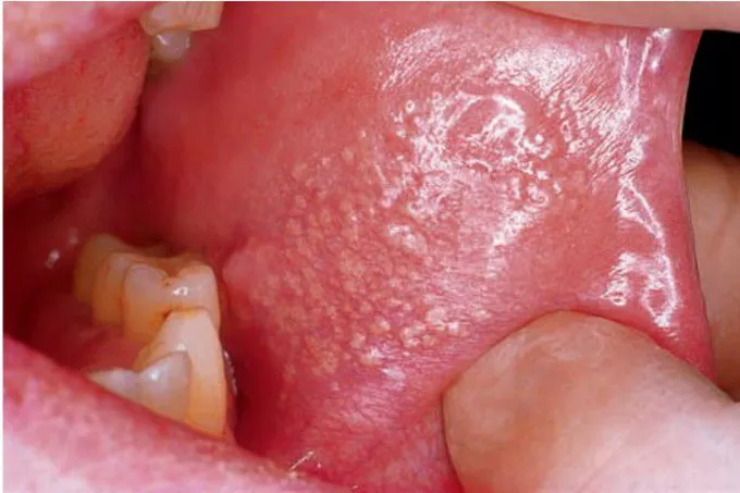 Fordyce granules inside mouth – mucosal appearance Fordyce granules on the inner side of the mouth, small whitish spots on the mucosa, dermatological condition example.