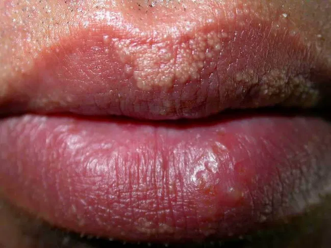 Fordyce granules on lips – causes and treatment Close-up view of lips with Fordyce granules, small pale spots on the lip line, dermatological condition illustration.