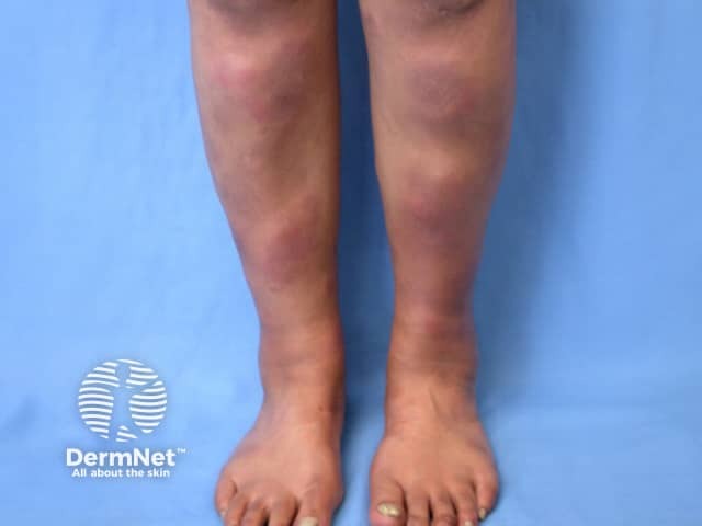 Verbetering van de benen tijdens compressietherapie bij erythema nodosum