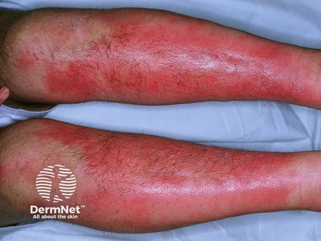 Rode huiduitslag en zwelling op de onderbenen bij ontstekingsziekte erythema nodosum