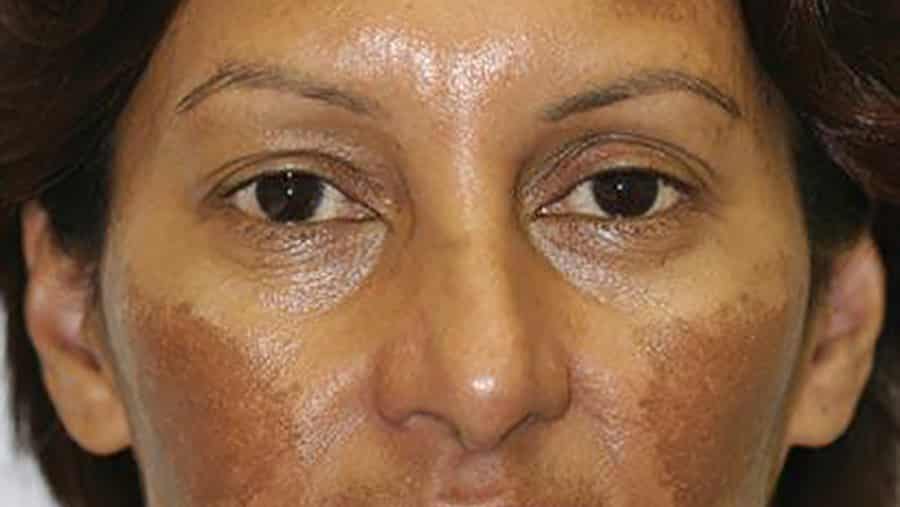 Dark brown patches on cheeks and forehead typical of melasma