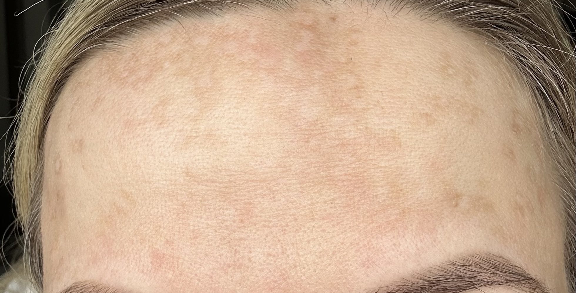 Subtle brown patches on the forehead showing mild melasma