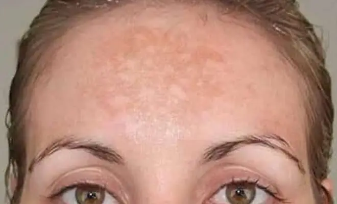 Light brown patches on the forehead caused by melasma