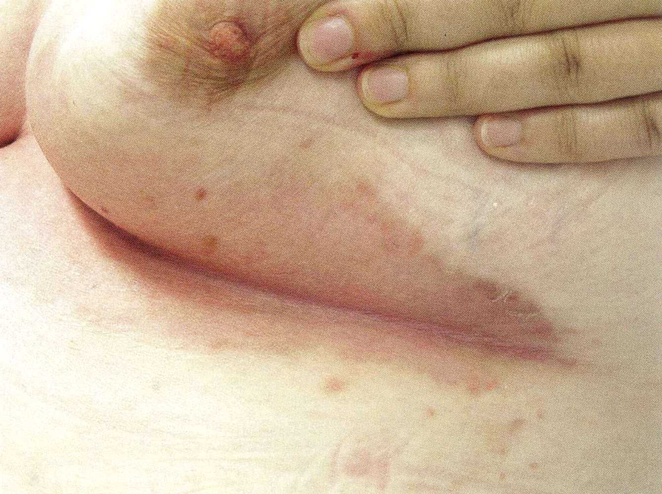 Erythrasma in a skin fold – a well-defined reddish-brown patch