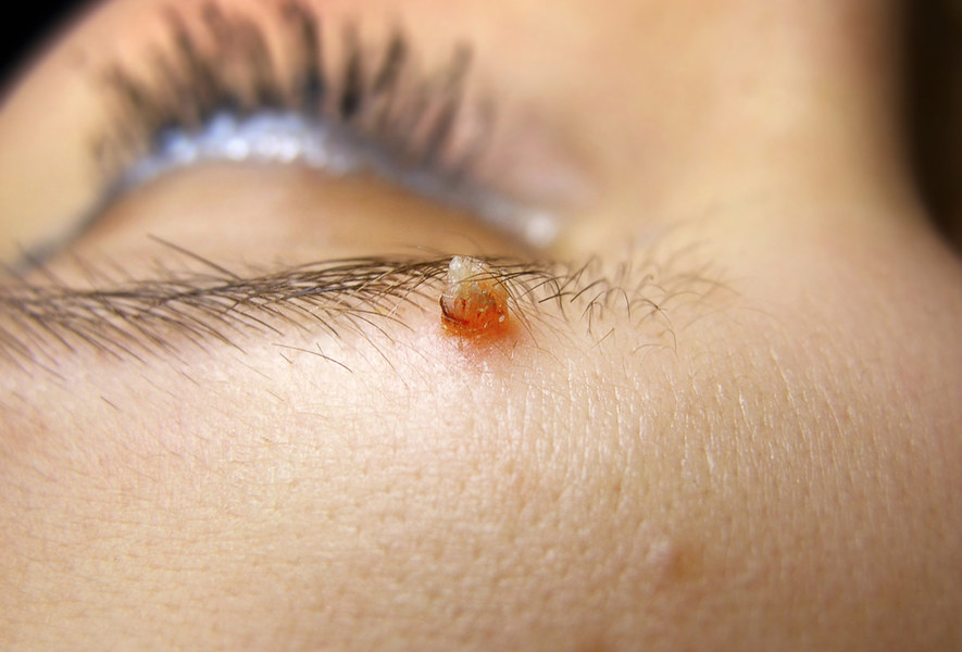 Small papilloma on upper eyelid near eyelashes Small papilloma on upper eyelid near eyelashes