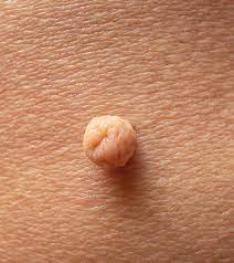 Close-up of a soft fibroma (skin tag) on skin surface