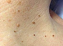 Multiple small skin tags (soft fibromas) on the neck