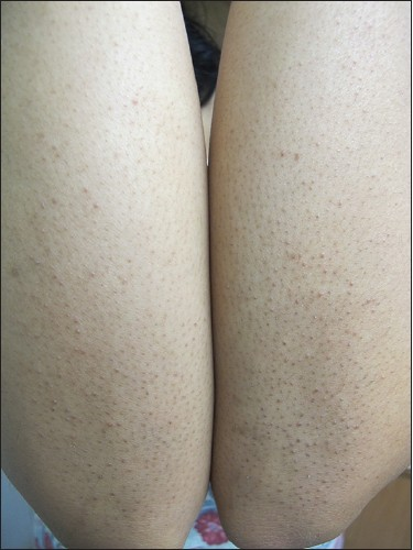 Close-up of follicular keratosis on thighs with small rough bumps Close-up of follicular keratosis on thighs with small rough bumps