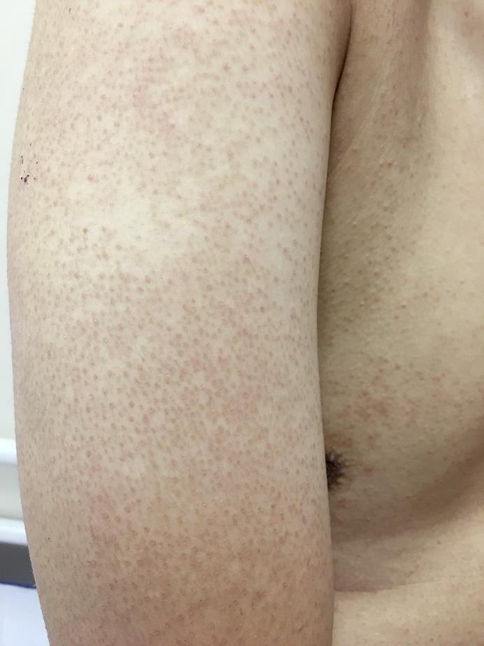 ghk cu keratosis pilaris Keratosis pilaris - goosebumps