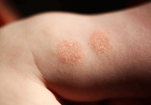Nummular eczema on child’s skin showing round dry patches Nummular eczema on child’s skin showing round dry patches