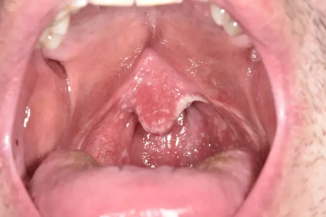 Oral candidiasis (thrush) showing white coating and redness inside the mouth