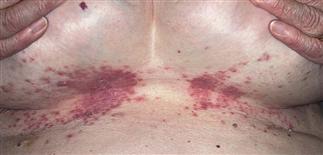 Candidiasis infection under the breasts causing red patches and irritation