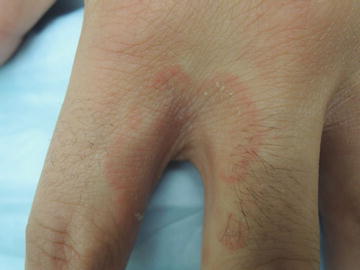 Fungal infection between fingers showing redness and scaling