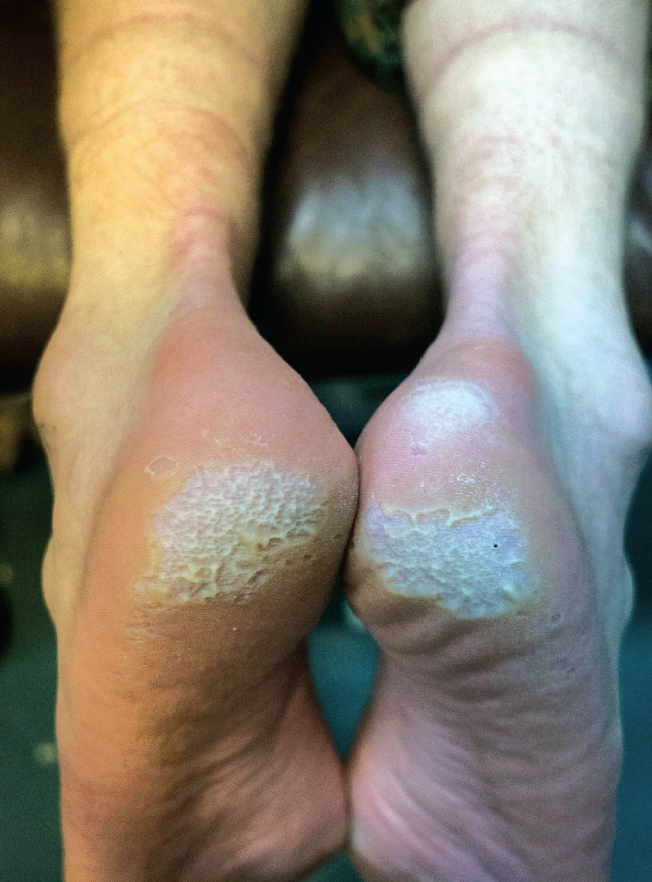 Heels with thickened, cracked skin showing signs of keratolysis and callus formation. Heels with thickened, cracked skin showing signs of keratolysis and callus formation.