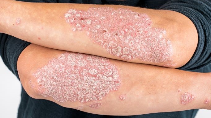 Extensive silvery scales and red plaques on forearms typical of chronic plaque psoriasis. Extensive silvery scales and red plaques on forearms typical of chronic plaque psoriasis.