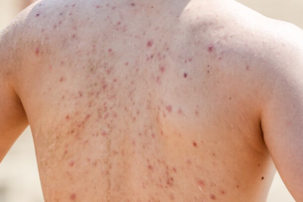 Back acne (bacne) showing multiple red pimples, spots and inflammation across upper back