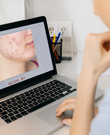 Doctor Reviewing Acne Case on Laptop Mobile Doctor Reviewing Acne Case on Laptop Mobile