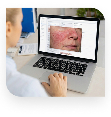 Side profile of young woman showing severe acne rosacea skin condition mobile