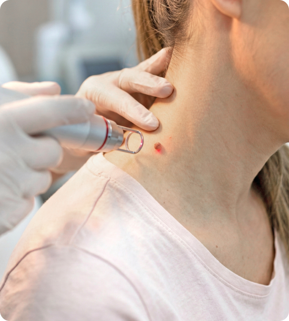 Dermatologist performing laser removal of a skin papilloma Dermatologist performing laser removal of a skin papilloma
