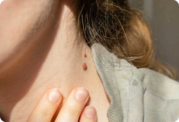 Close-up of female neck showing multiple moles and skin spots Close-up of female neck showing multiple moles and skin spots