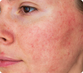 Close-up of diffuse skin redness and flushing on a cheek. title.erythematous.pink