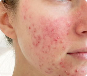 Close-up of inflammatory acne bumps and blemishes on the jawline. title.papulopustular.form