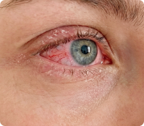 Extreme close-up of an inflamed, bloodshot eye. title.ophthalmic.form