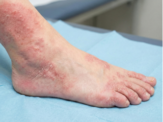 /images/dermatitis/trail-11.png