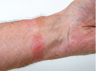 /images/dermatitis/trail-8.png