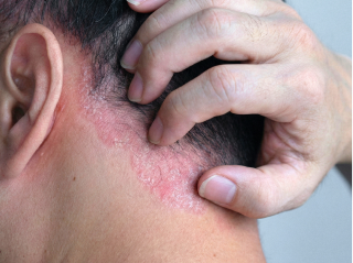 /images/dermatitis/trail-9.png
