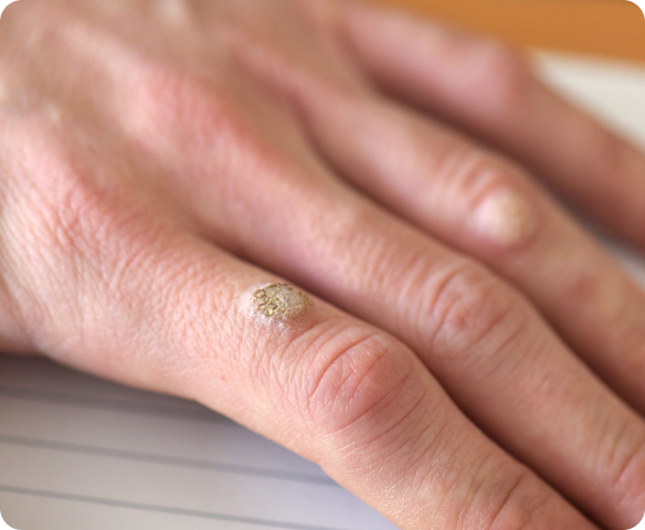 Close-up of a rough cutaneous wart on a finger A close-up view of a person's index finger showing a raised, rough-textured, and hyperkeratotic skin growth near the knuckle, typical of a common viral wart