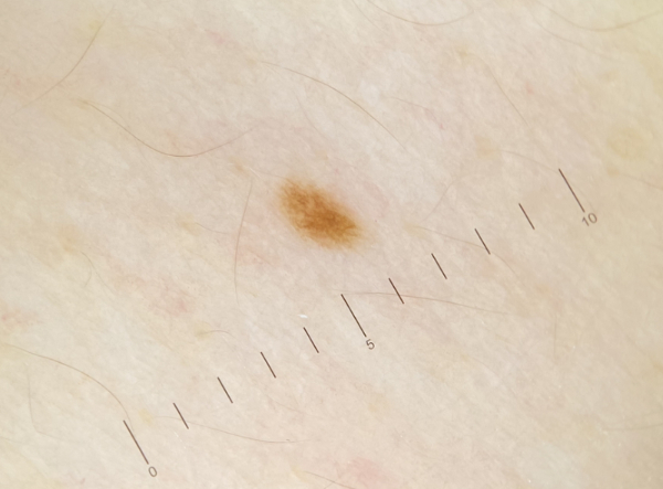 Labai padidintas apskritas pigmentinio odos pažeidimo dermoskopinis vaizdas, kuriame matomos smulkios pigmentų tinklo struktūros, kurias dermatologai naudoja diagnostikai.